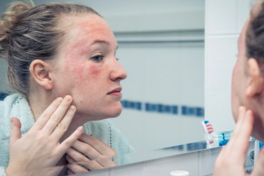 rosacea