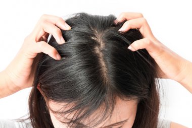 dandruff