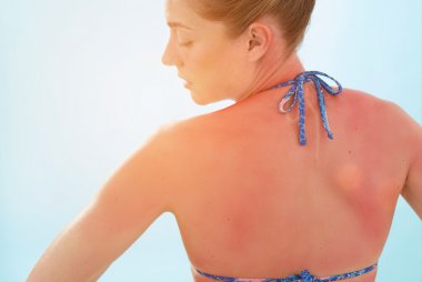 sunburn