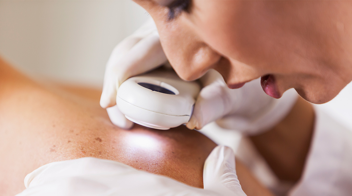 basal-cell-carcinoma