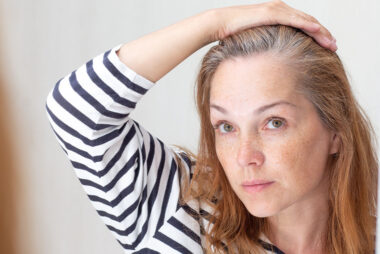 female-pattern-hair-loss